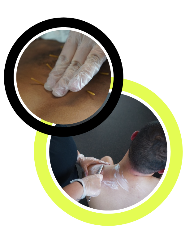 Recovery Specialist performing dry needling on the upper back and shoulder